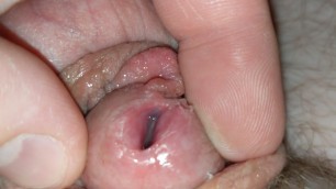 Gaped Urethra 11mm Sound