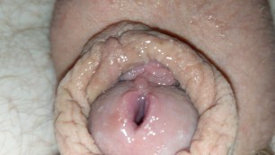 Gaped Urethra (10MM)